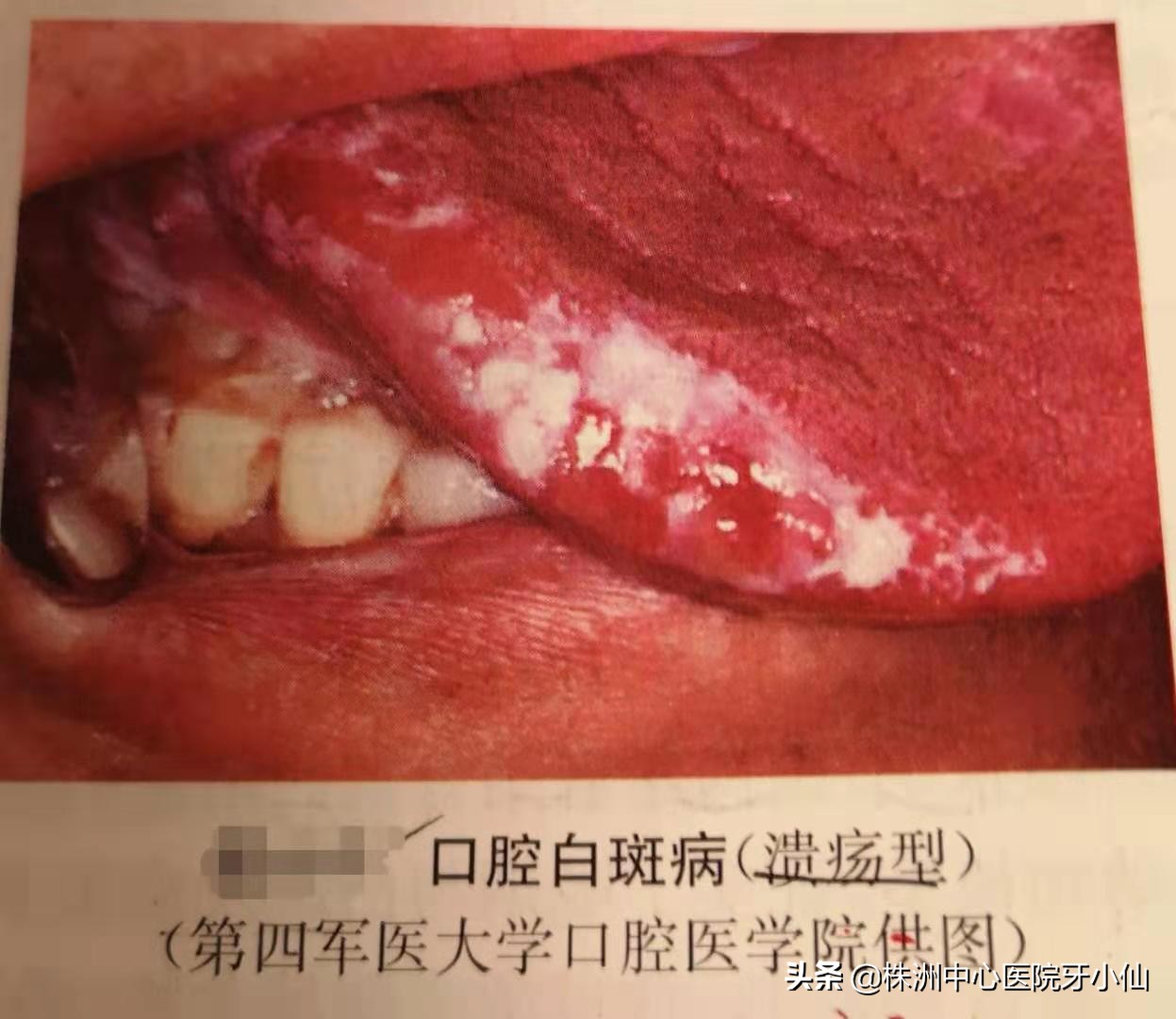 口腔白斑是白色念珠菌感染吗,口腔白斑和吃槟榔有关吗