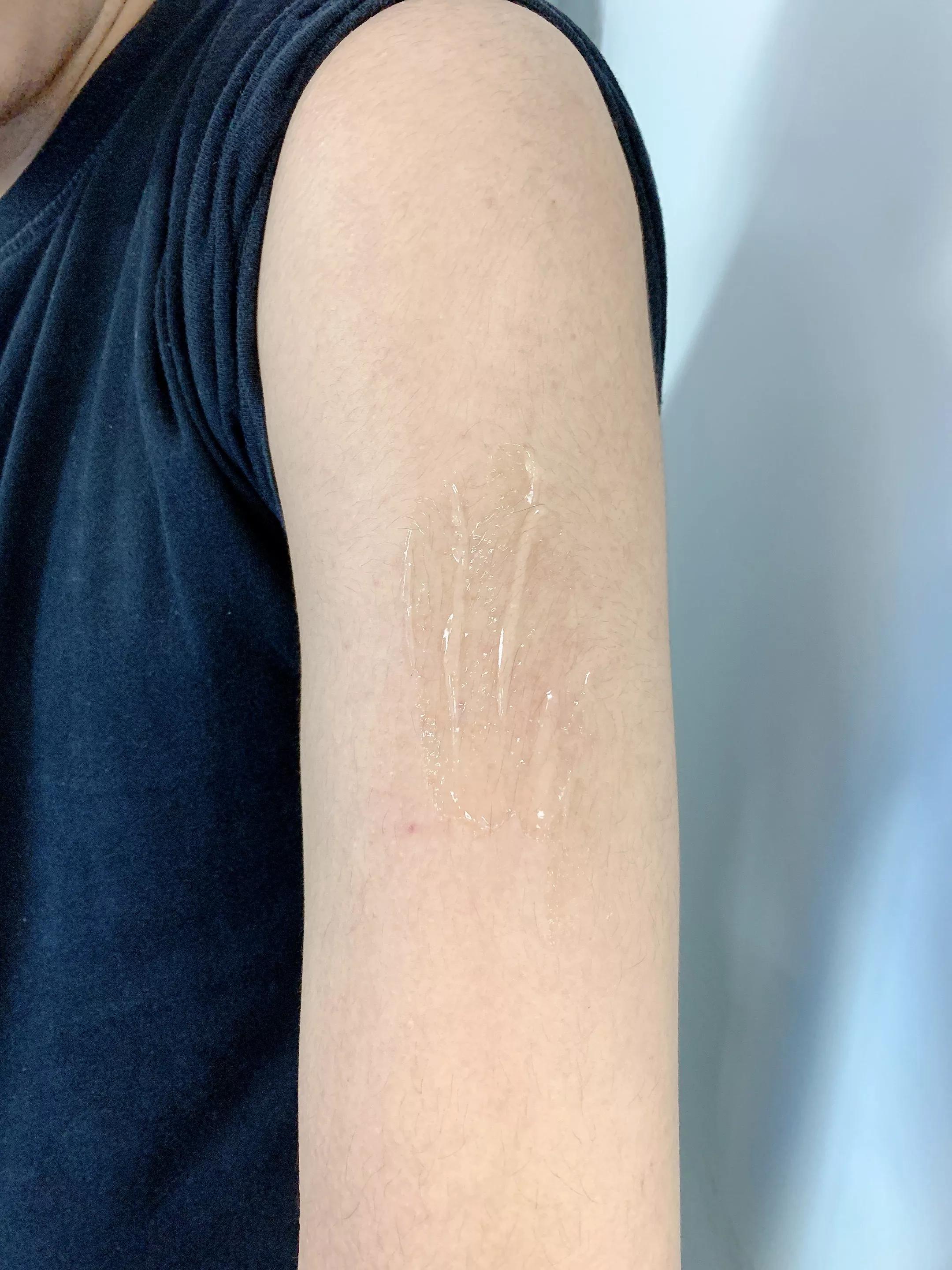 男朋友手臂上长很多小痘痘,男朋友手臂很多痘痘