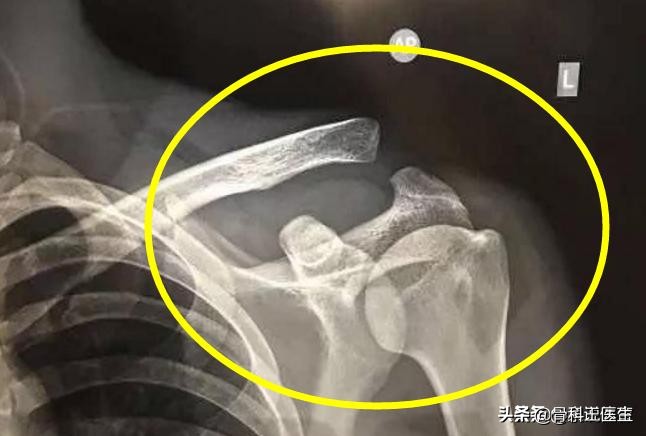 武磊肩锁关节脱位怎么治疗,武磊肩部受伤
