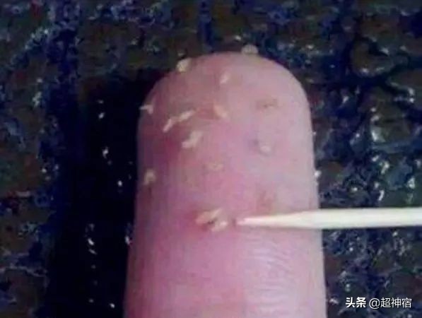 如何预防闭口长出并解决闭口问题,教你5个根治闭口粉刺方法