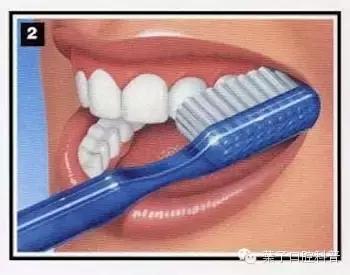 拉锯式刷牙可能造成牙齿缺损,暴力刷牙造成牙齿楔状缺损