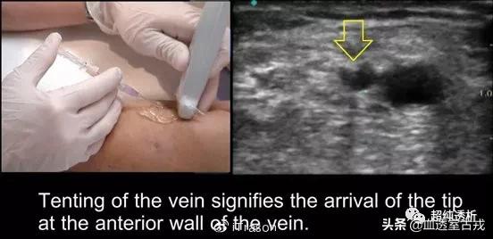 超声引导下血管穿刺效果评价,超声引导下血管穿刺置管流程
