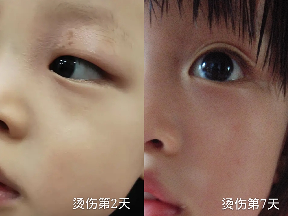 高温烫伤的防护措施与处理方法,宝宝烫伤安慰妈妈