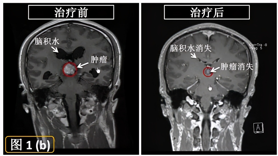 伽玛刀治疗疾病的优点,伽玛刀治疗什么病