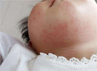 宝宝长湿疹后皮肤受损怎么护理,婴儿面部湿疹怎么护理效果最好