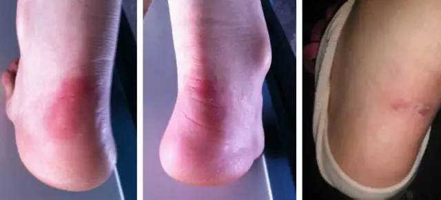 每个女生脚后跟都有个疤,每个女人的背后都有一部辛酸史