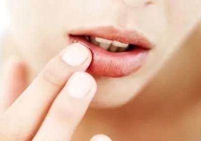口唇上火起泡中医怎么治,嘴上起泡中医认为是什么火