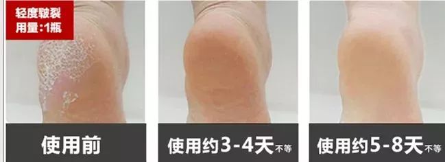 手上冻疮干裂怎么办,手脚冻脸上冻疮三天快速消除
