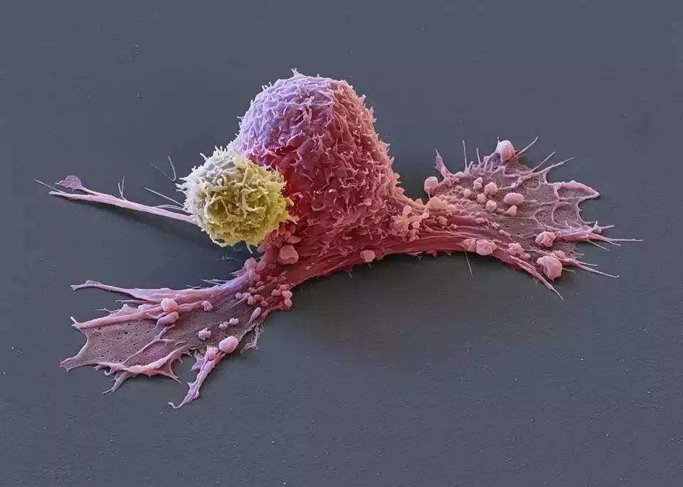 她因癌症病逝,她因为胃癌只能活5年