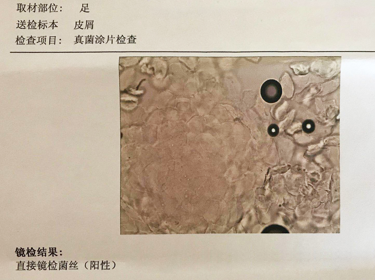 脚丫子足癣,烂脚丫怎么治疗足癣