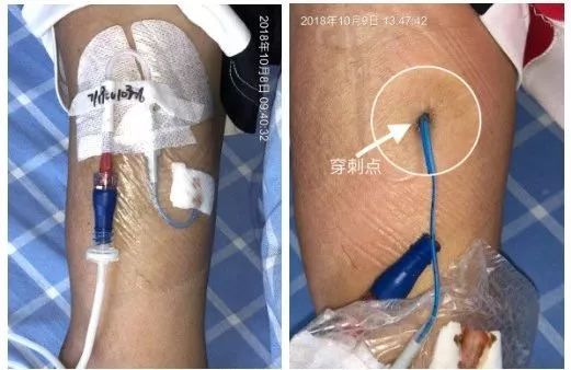picc穿刺点有脓咋办,picc导管穿刺部位渗血