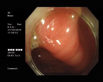 治疗阑尾炎需要手术吗,阑尾炎为什么选择保守治疗呢