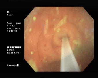 治疗阑尾炎需要手术吗,阑尾炎为什么选择保守治疗呢