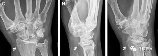 肩关节脱位易漏诊的骨折,放射科容易漏诊的骨折