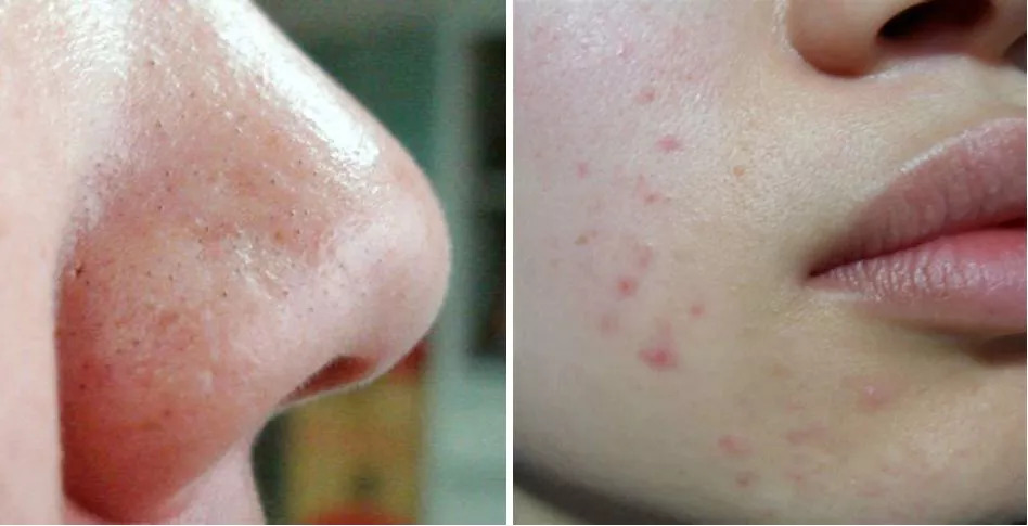 去黑头去角质慕斯,3分钟祛除黑头