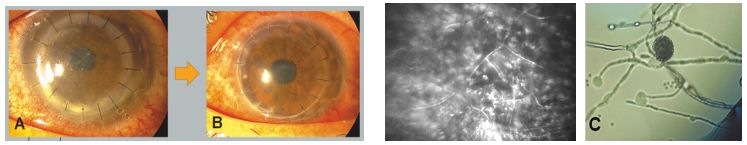 孙旭光眼科医生,孙旭光大夫角膜塑形镜危害