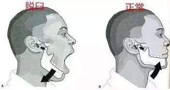 健康｜吃个甘蔗，下巴被吃“掉”了？