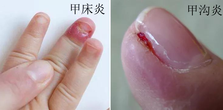 十年灰指甲可以治好吗,一次搞定顽固灰指甲