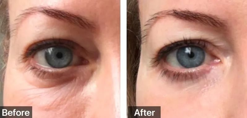 不削骨改变脸型,不削骨变脸型