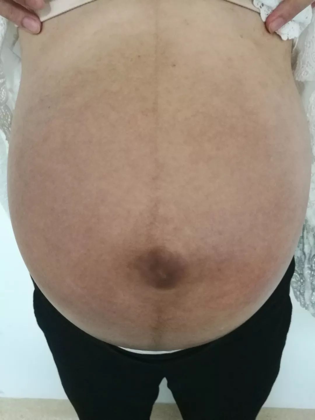 孕妇湿疹不可怕，中医治疗有奇效