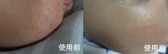 告别秋冬干燥肌肤,告别小糙脸