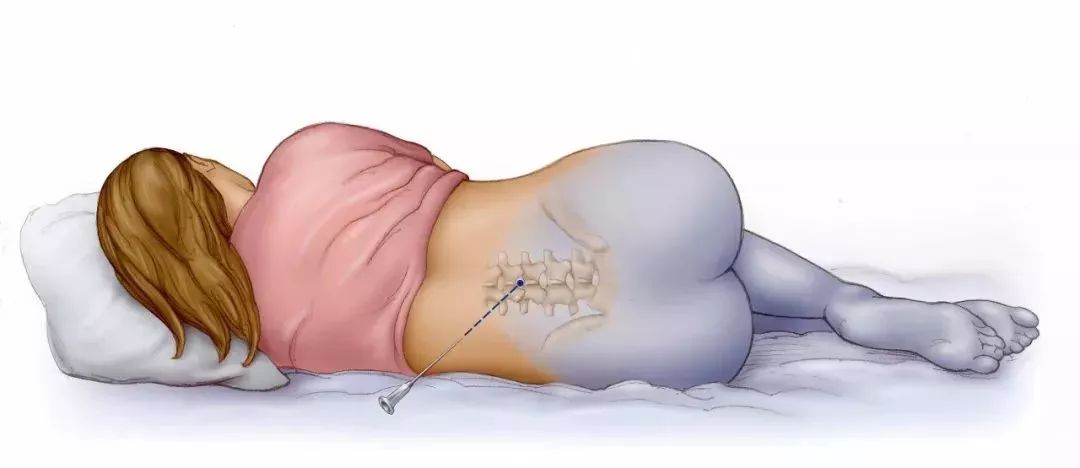 无痛分娩全国推广试点医院,孕妇无痛分娩全国推广