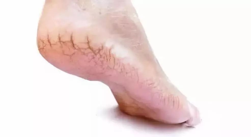 脚后跟鱼鳞状干裂用什么药,脚后跟干裂小腿长鱼鳞