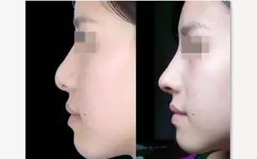 玻尿酸一打就是个无底洞,打玻尿酸现在是不是还挺普遍的