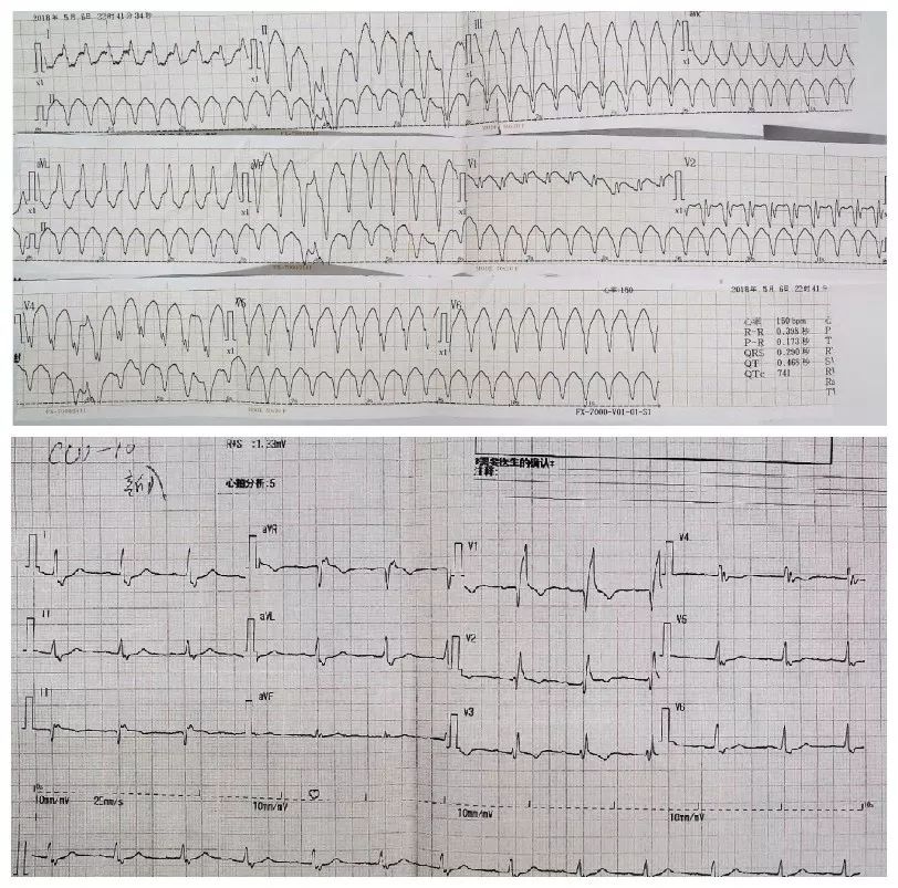 拯救反复心梗发作后心衰患者，积极血运重建和规范药物治疗一个都不能少！