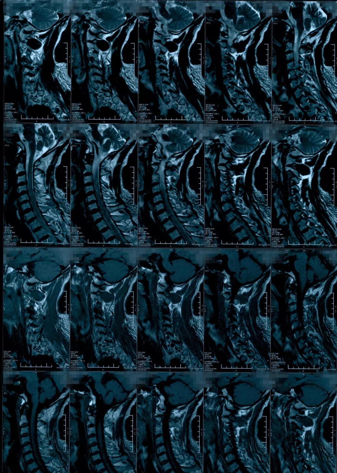 椎管狭窄水肿最佳治疗方法,椎管水肿如何治疗