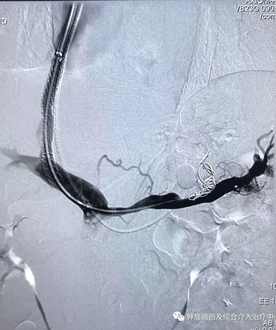 运城市第一医院肿瘤科咋样,运城第一医院治疗肿瘤怎么样