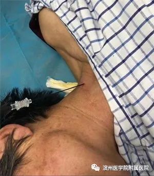 缠腰龙又疼又痒怎么办,缠腰龙疼起来很要命