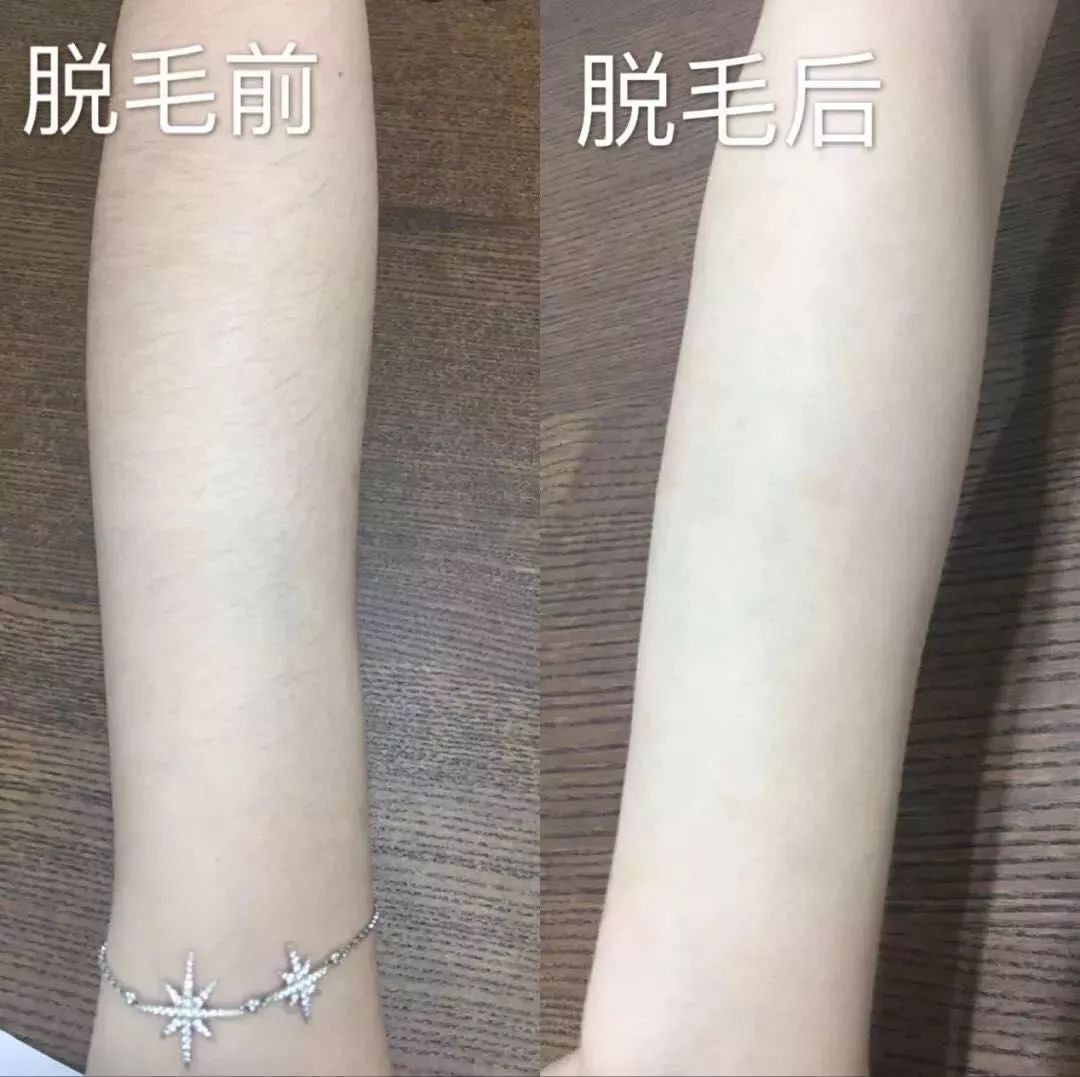 亲测有效果的脱毛秘方,亲测脱毛