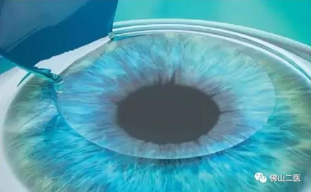 激光近视手术需要多少钱,做近视手术后需要注意事项