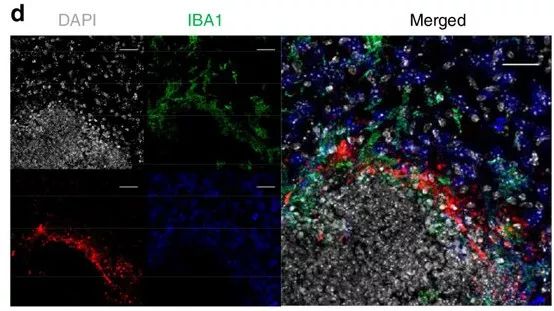 混合性痴呆致病因素,炎症会导致痴呆吗