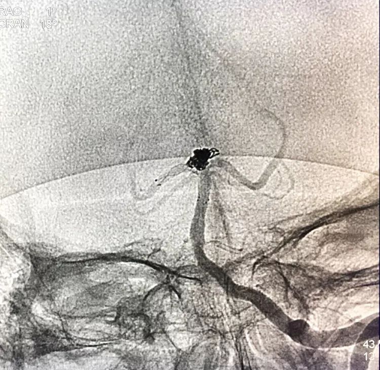 柳暗花明专栏｜栓塞颅内动脉瘤时微导管无法穿过LVIS支架网眼怎么办