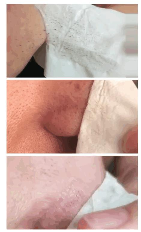 白头黑头到底拔不拔,黑头反反复复如何根治