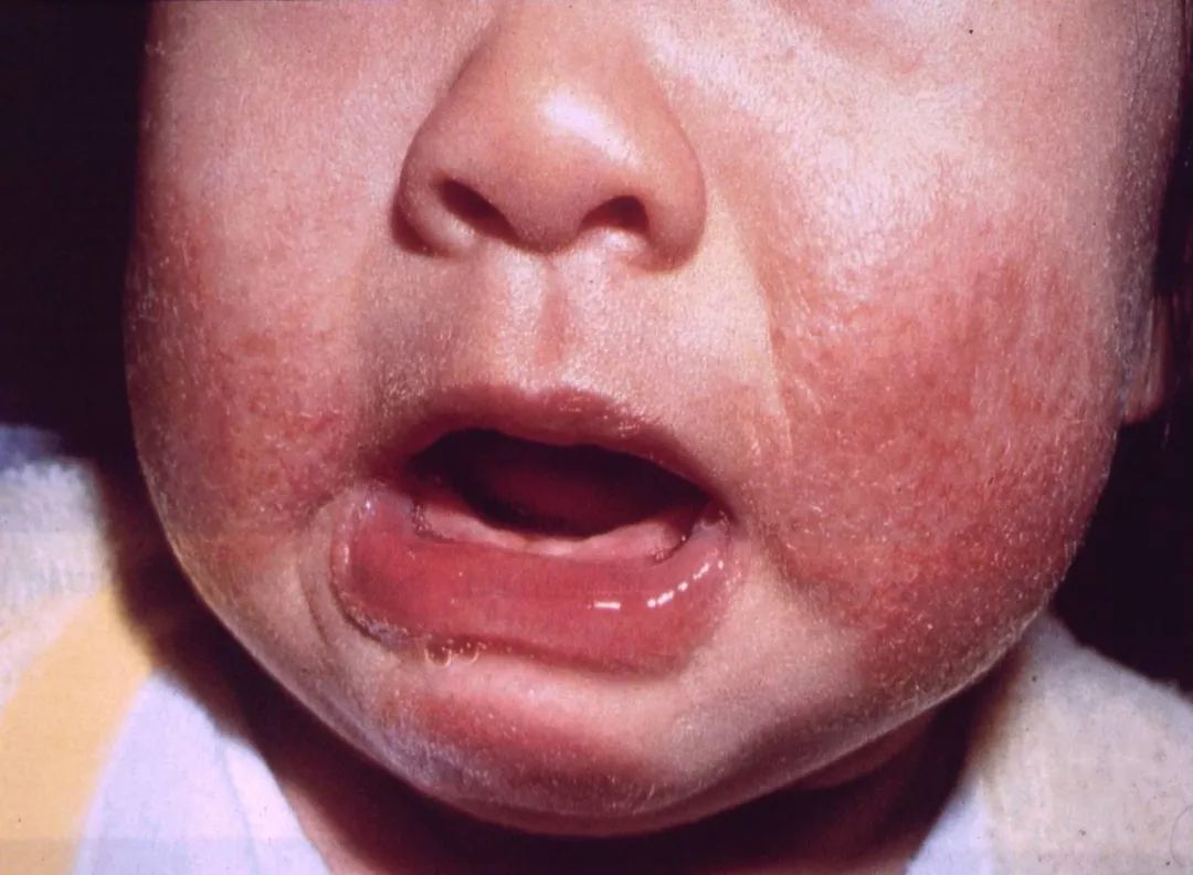 宝宝湿疹反反复复就是不好,宝宝湿疹反反复复就是好不了