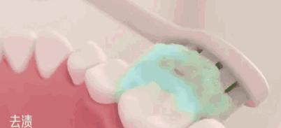 日本牙膏修复牙洞是真的吗,为什么日本人牙那么白