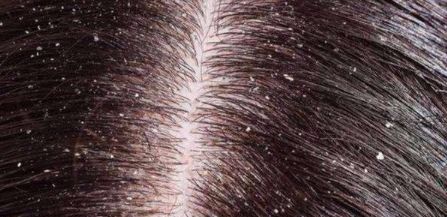 头皮屑洗不掉怎么办有什么方法,头发头皮屑多且大块还结痂有虫