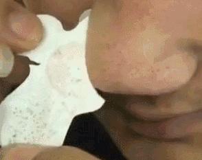 拨黑头工具草莓鼻,去黑头神器真的能吸出黑头