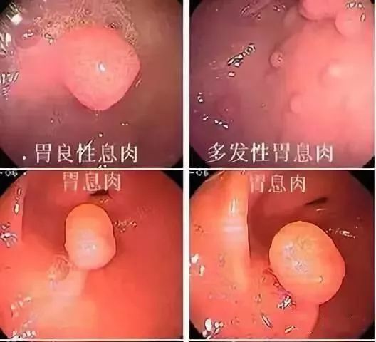 一文盘点|临床上常见的息肉病