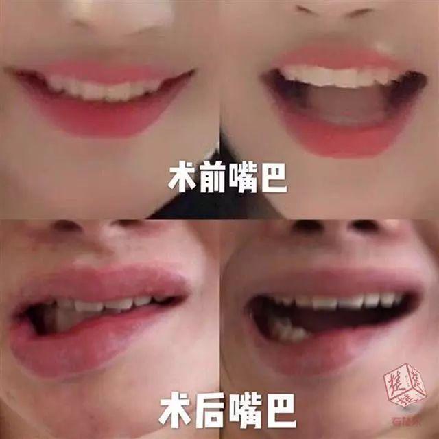 整容315事件真实案例,整容毁容真实案例如何赔偿