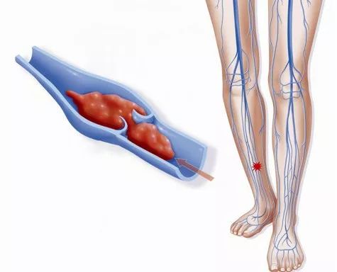 久坐久站小心下肢静脉曲张,久坐人群预防静脉血栓小技巧