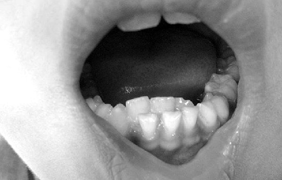 四岁半孩子乳牙掉了一颗,四岁半宝宝乳牙坏了不补可以吗