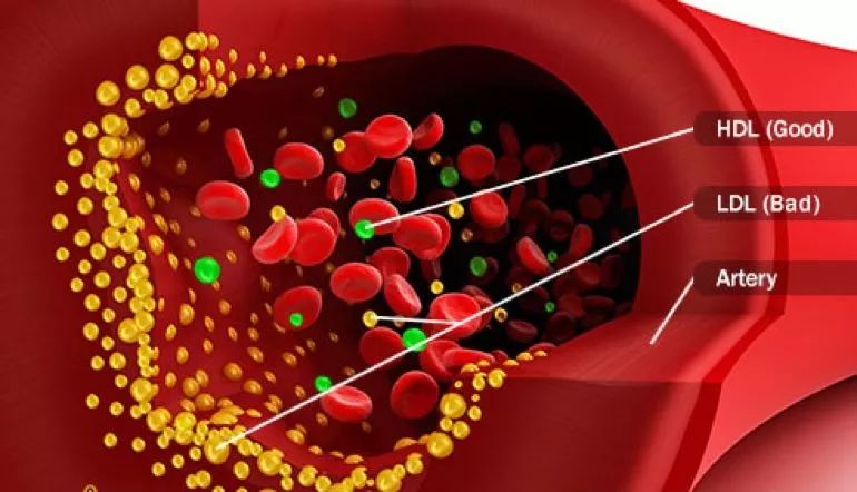 代谢综合征,代谢综合征通过运动能治愈吗