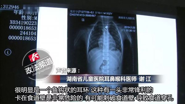 妈妈给孩子换尿布发现嘴里一个洞,儿童换尿布时吞耳环