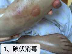 热水袋烧伤,热水袋烧伤起泡怎么处理