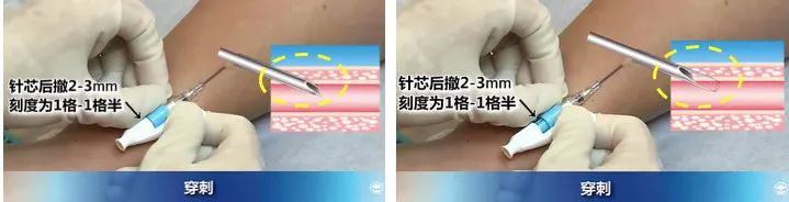 扎留置针有回血送针失败,留置针回血穿刺失败