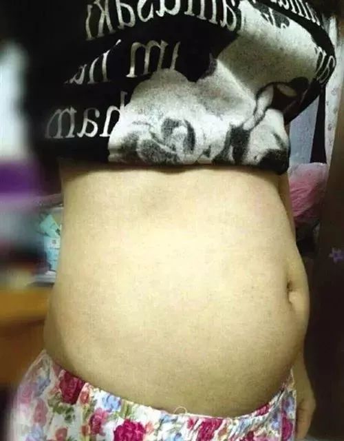 大二女生“卖卵”赚钱,肚子大得像孕妇!医生拼命拦下:你随时会死